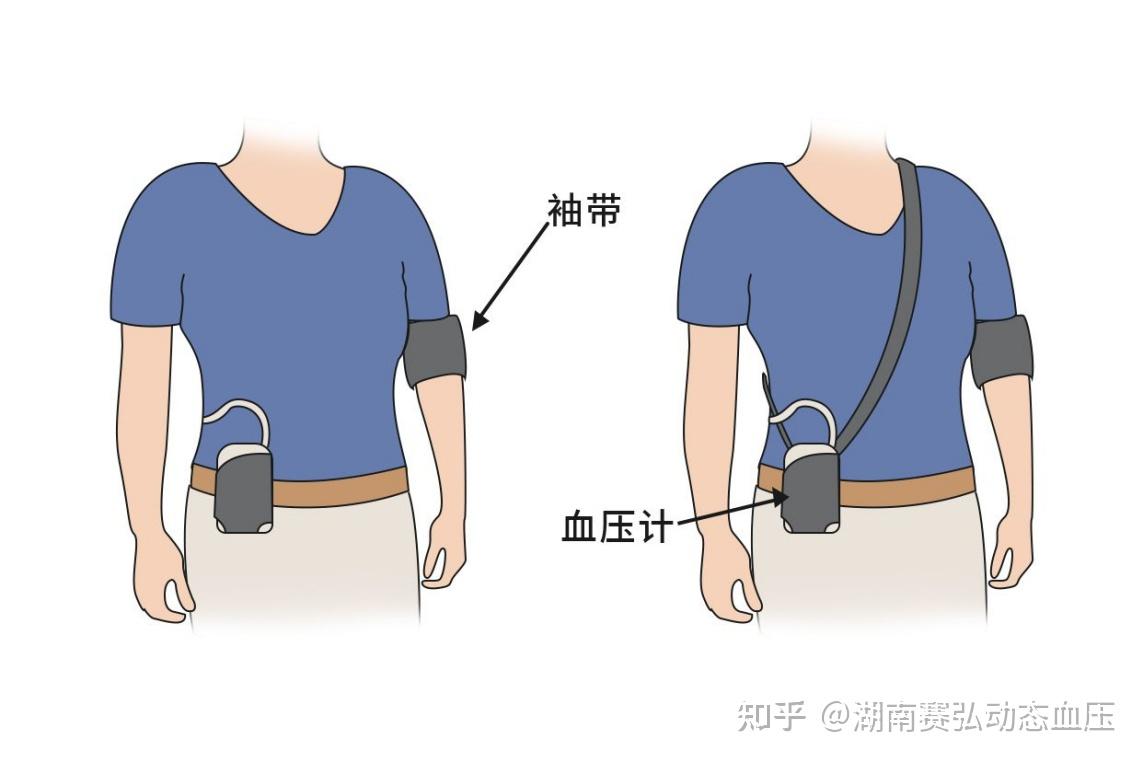 动态血压监测——高血压精准管理的“侦察兵” - 知乎