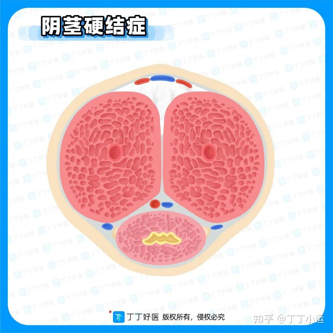 阴痉是什么图片