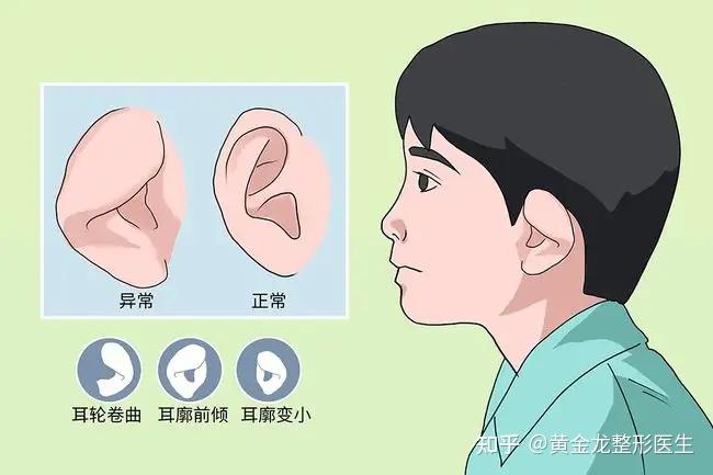 杯状耳矫正术后注意事项有哪些? - 知乎