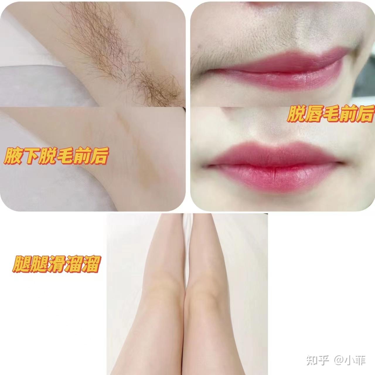 脱毛仪ulikeair3原理 脱毛仪ulikeair3原理