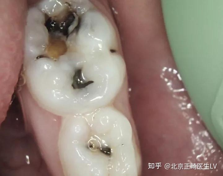 牙齿痛牙齿有黑线怎么办