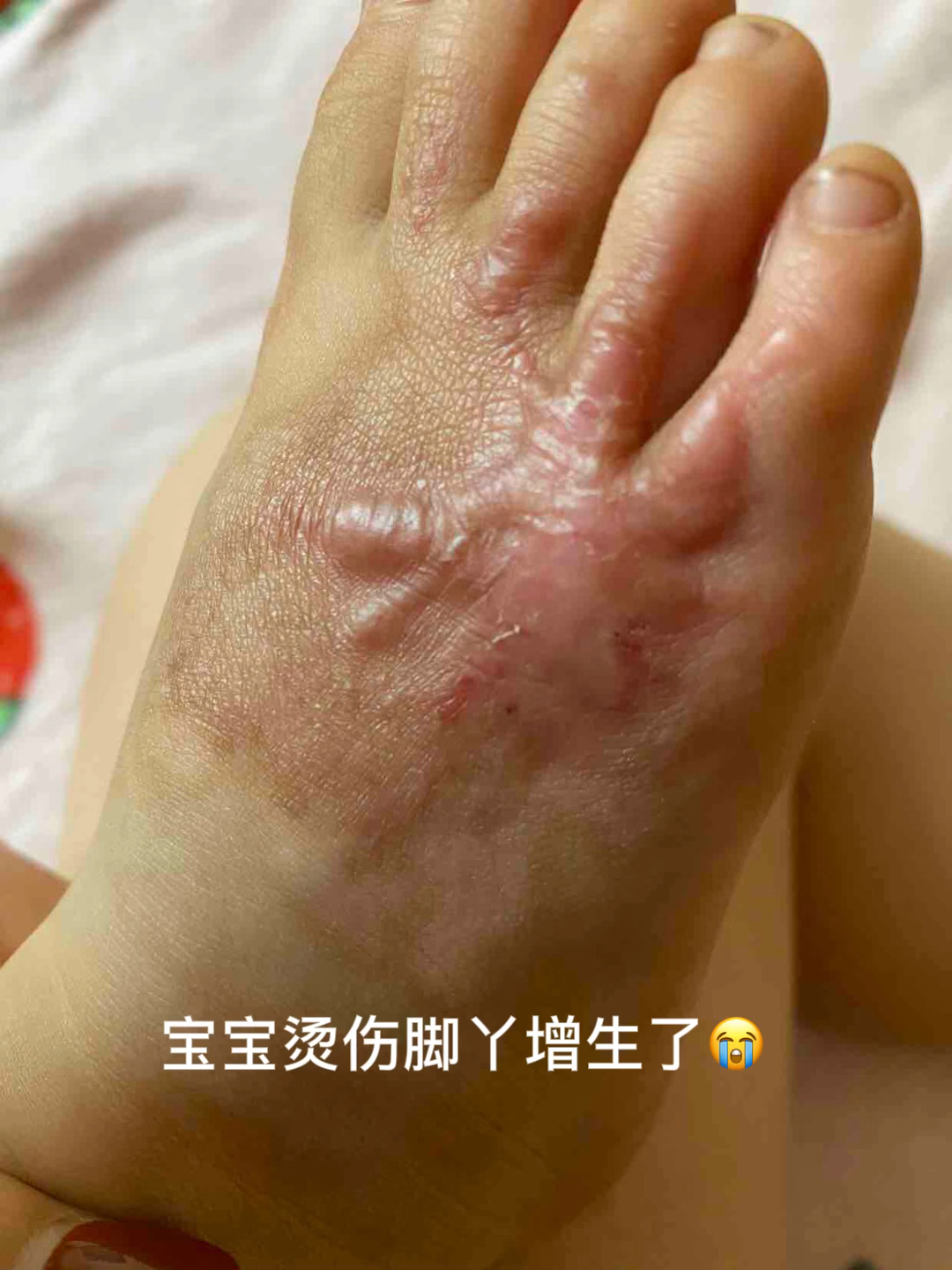 宝宝脚丫烫伤增生疤痕