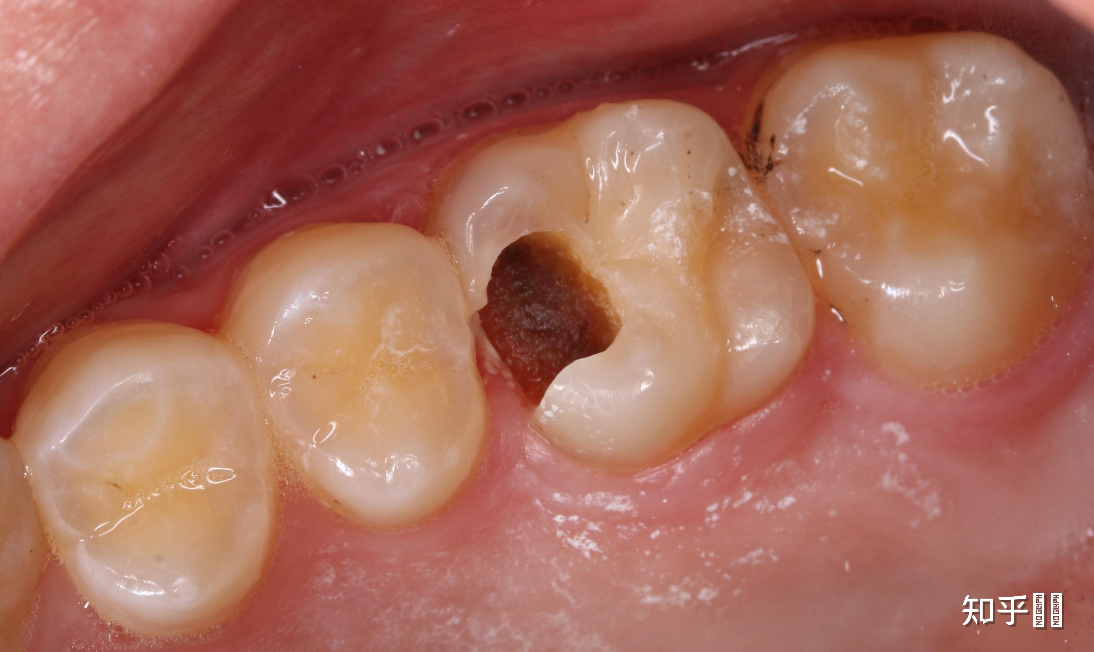 牙本质上黑色硬的腐质,不全去净也可以吗? - 知乎