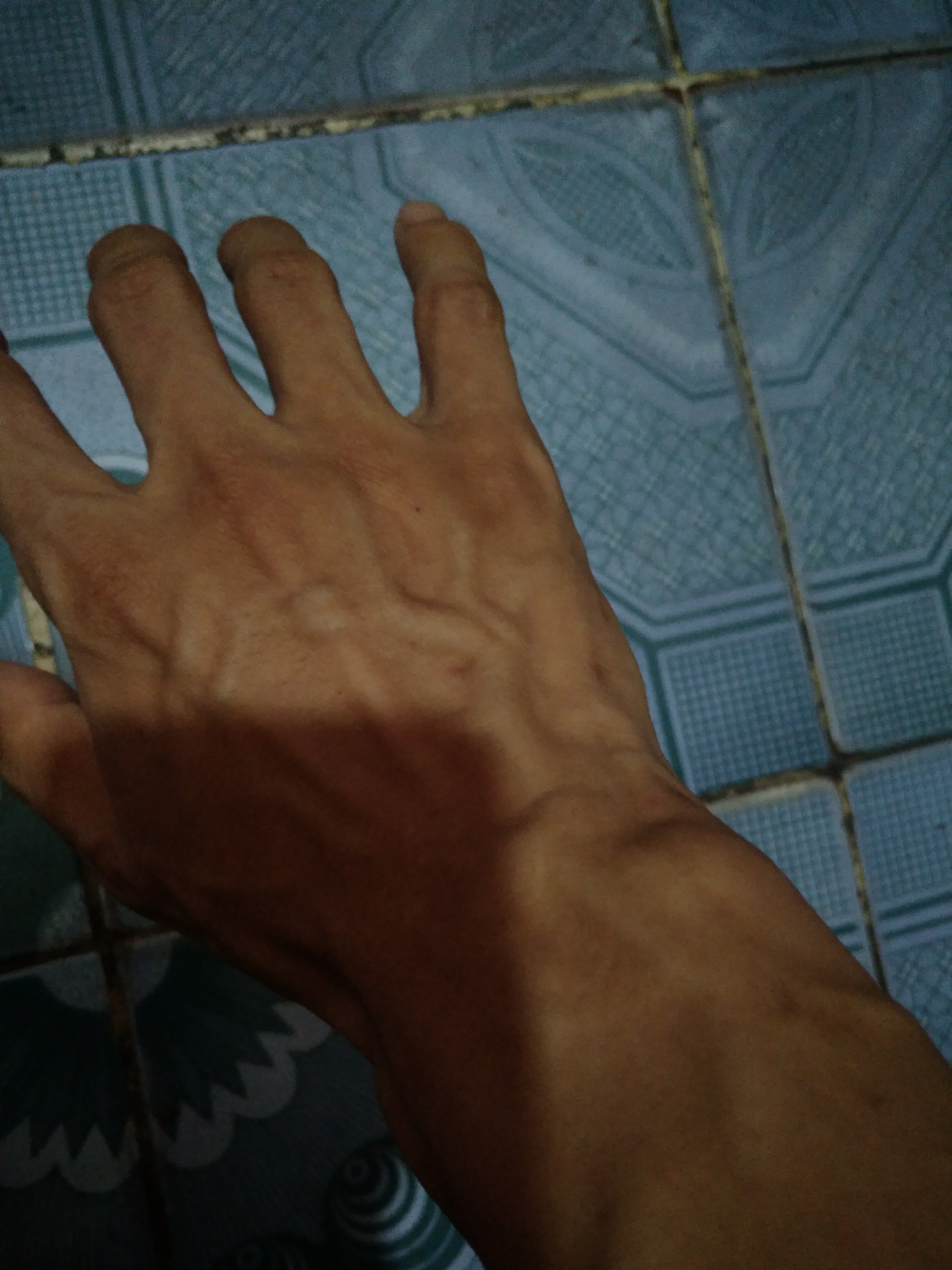 为什么我的手背上静脉血管那么明显?如何改善? - 知乎