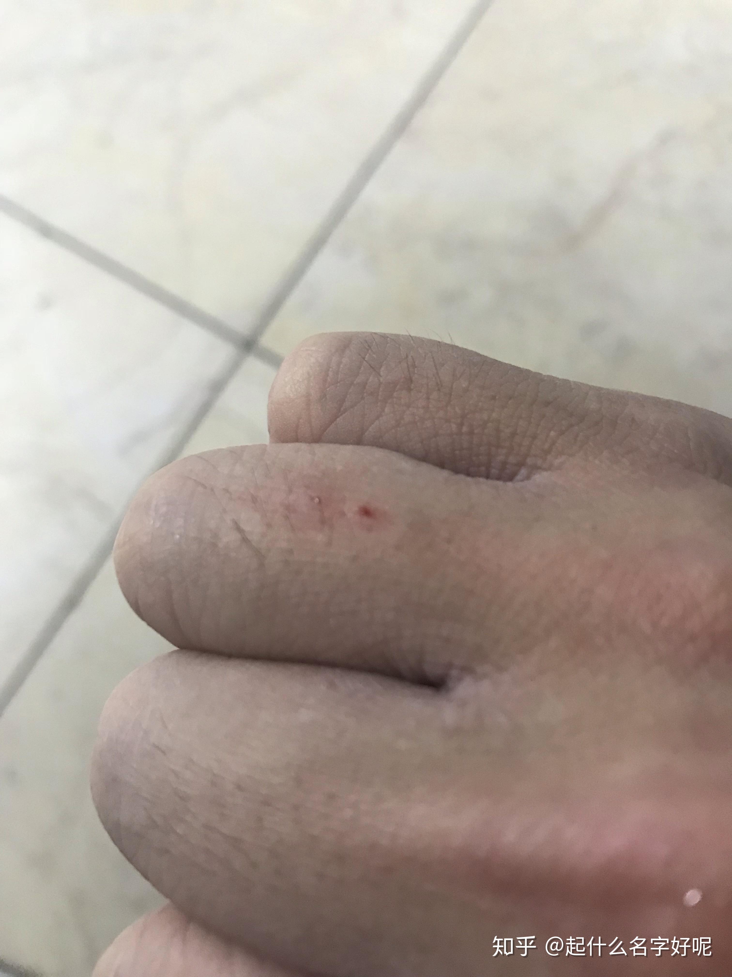 被猫抓划伤手指是否需要注射疫苗