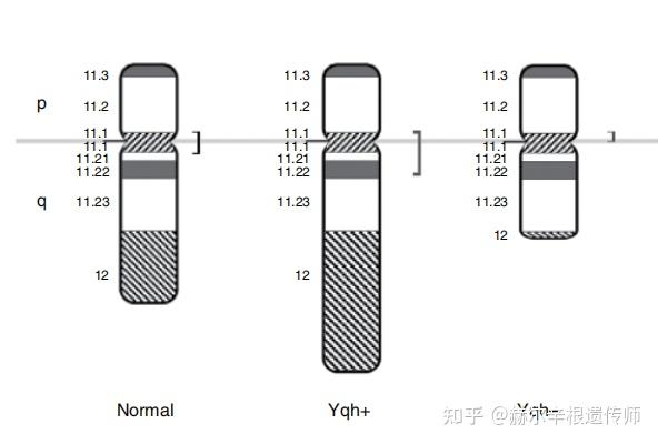 男性染色体46xy yqh 是什么意思?