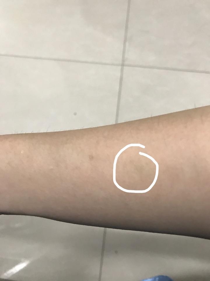 输液使用留置针后针眼处的皮下有包块怎么办? - 知乎