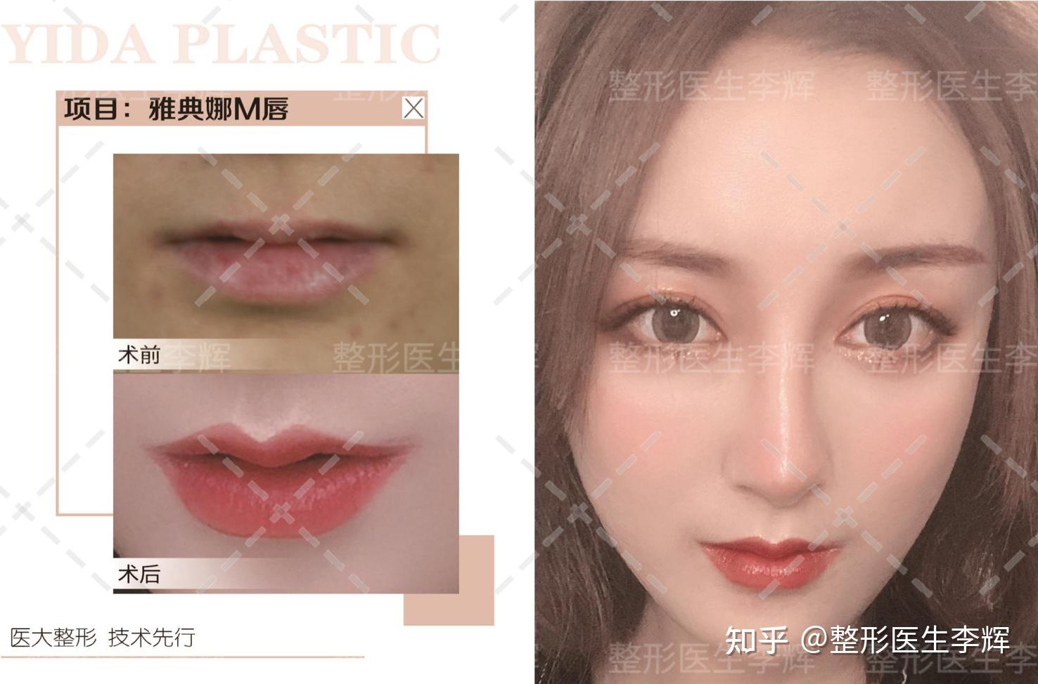 瘦唇手术是怎样的体验