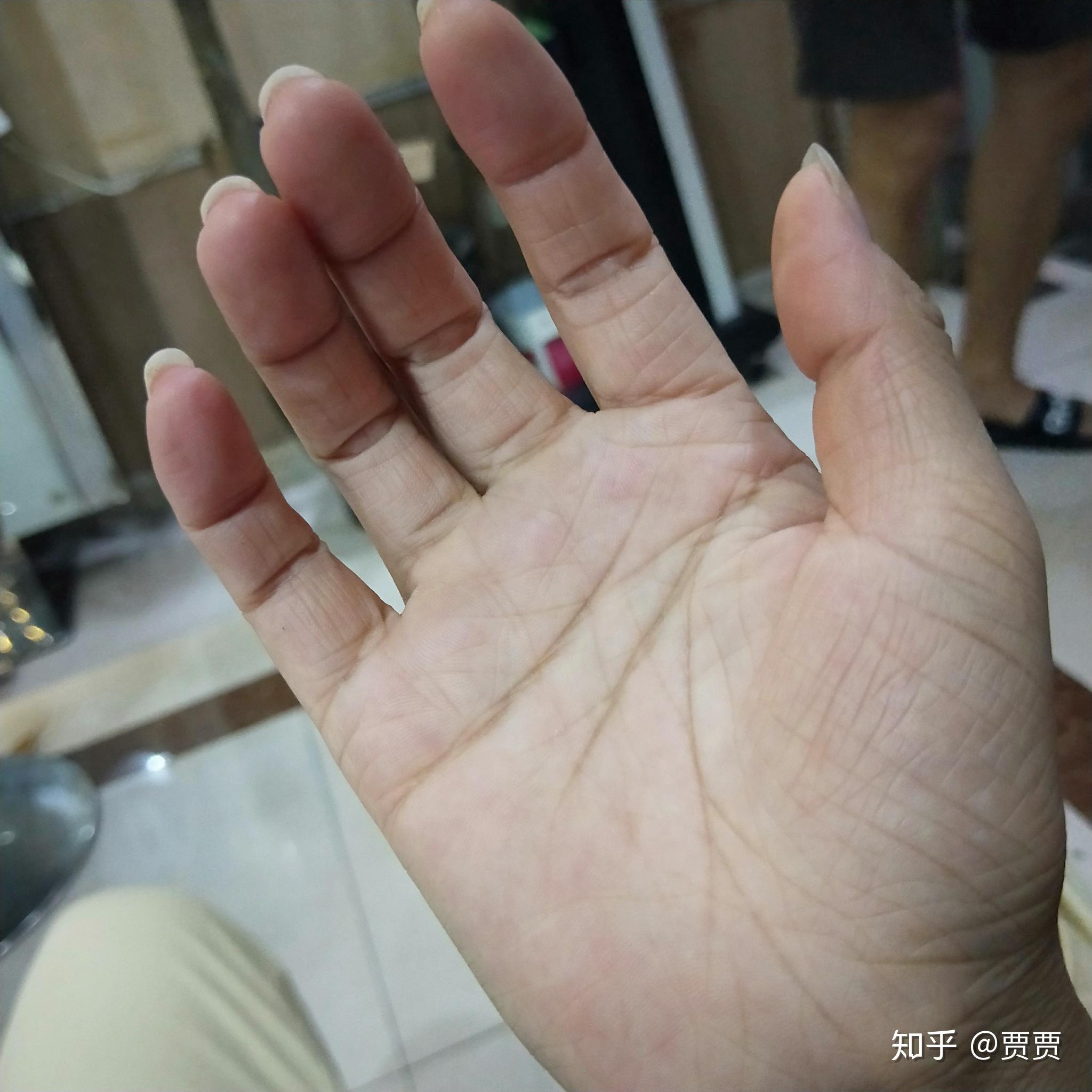 21岁女生手上很多皱纹像老人的手一样