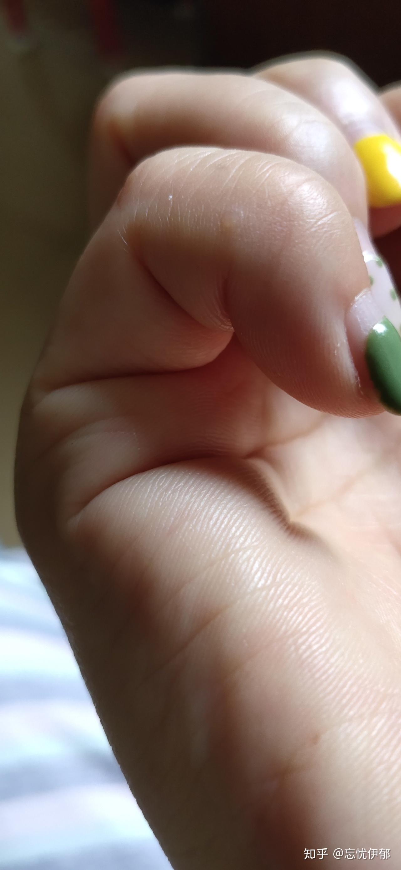 手部皮肤上长了透明小包(小疙瘩),不痛不痒,微硬,请问这是什么?