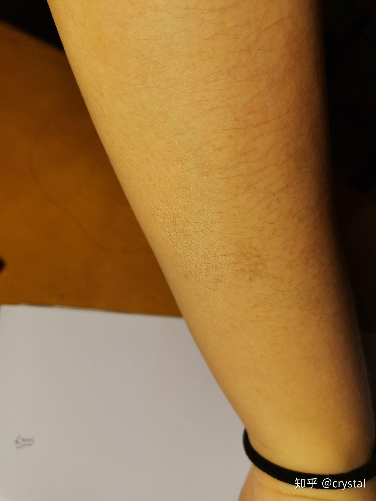 手臂的这是什么斑? - 知乎