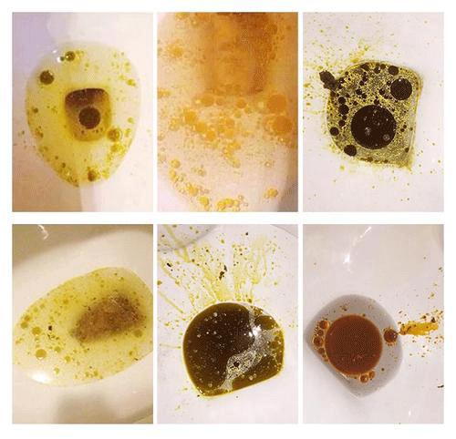 想问下吃过奥利司他减肥药的伙伴们有没有长过油性斑点