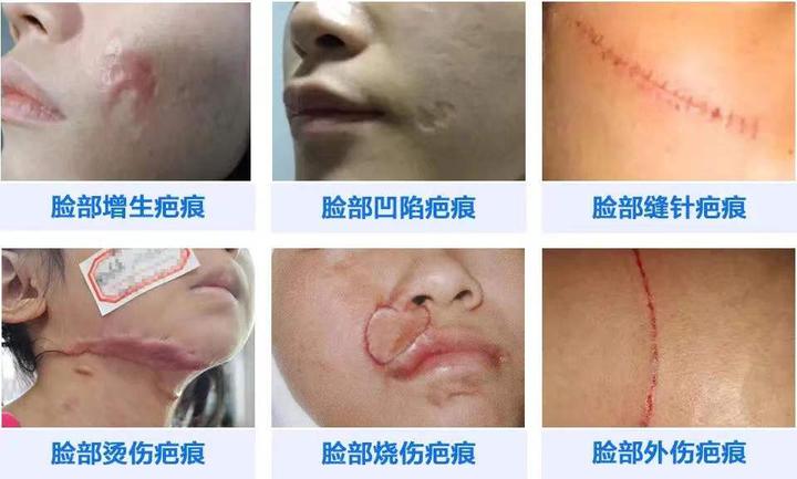 脸上有疤痕如何消除?新旧疤痕治疗方法各不同 - 知乎