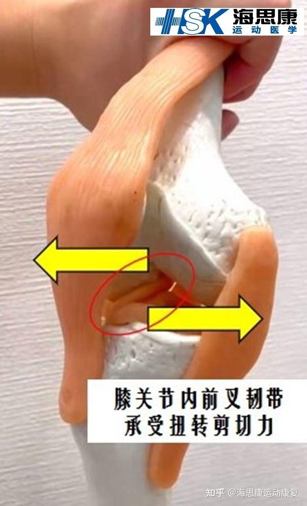前叉韧带在运动时是如何受伤的? - 知乎