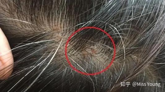 头皮上老是长痘痘,扣了是个血痂要不然就是按着疼的包,这是啥玩意啊? - 知乎