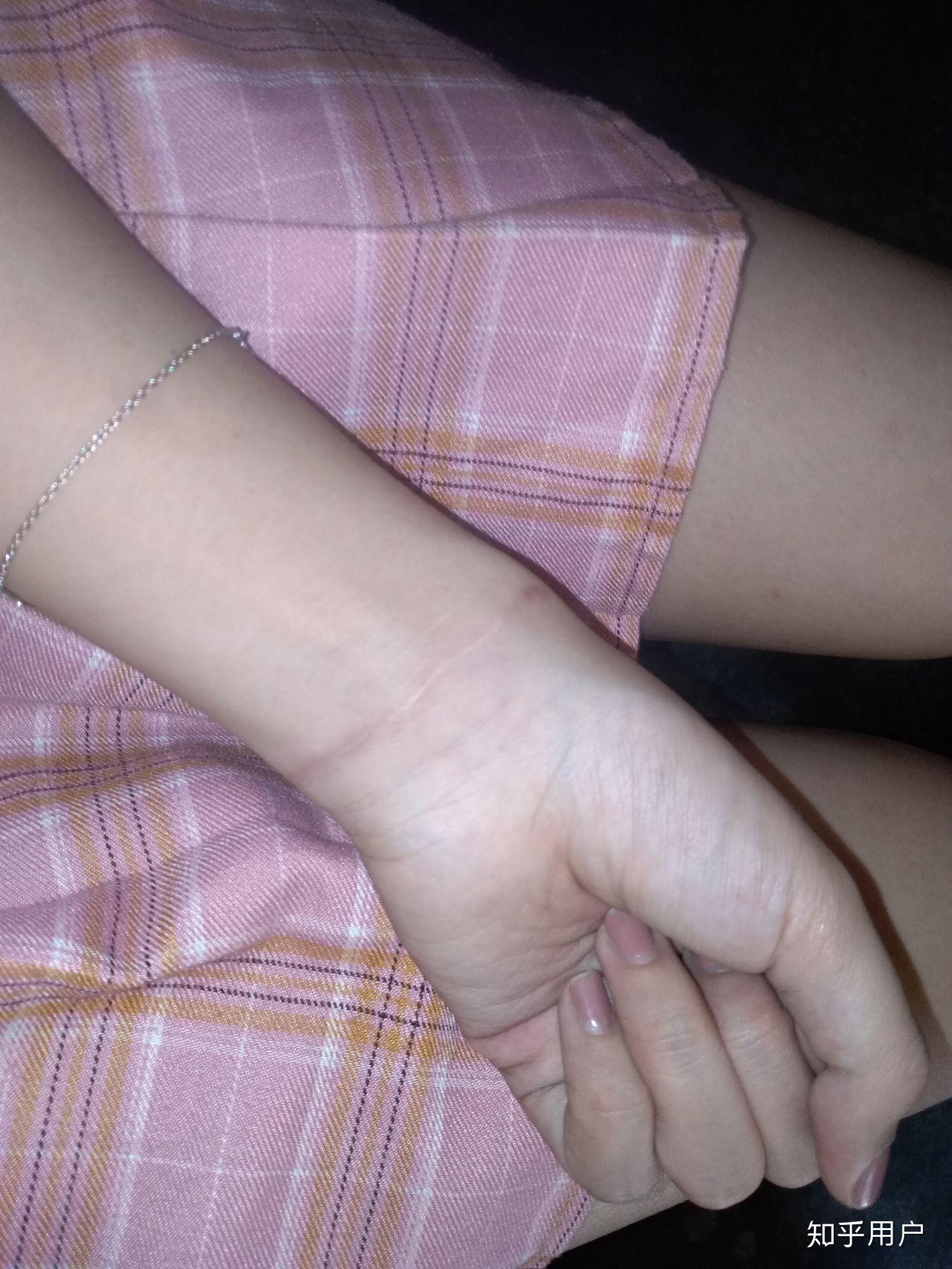 割腕的疤可以去掉吗