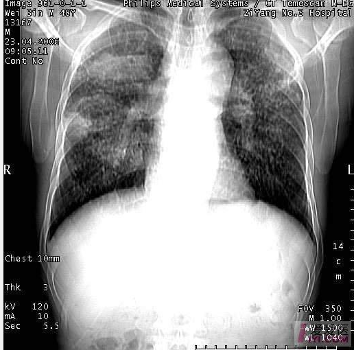 全国首例集体矽肺病工伤索赔案