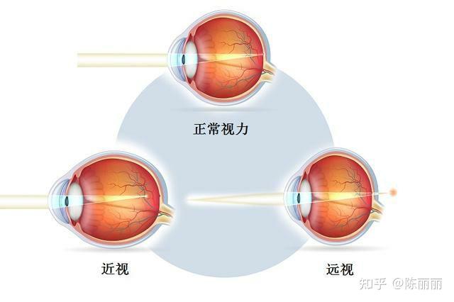 近视眼远视眼等人的各种眼睛看到的世界各是什么样子的