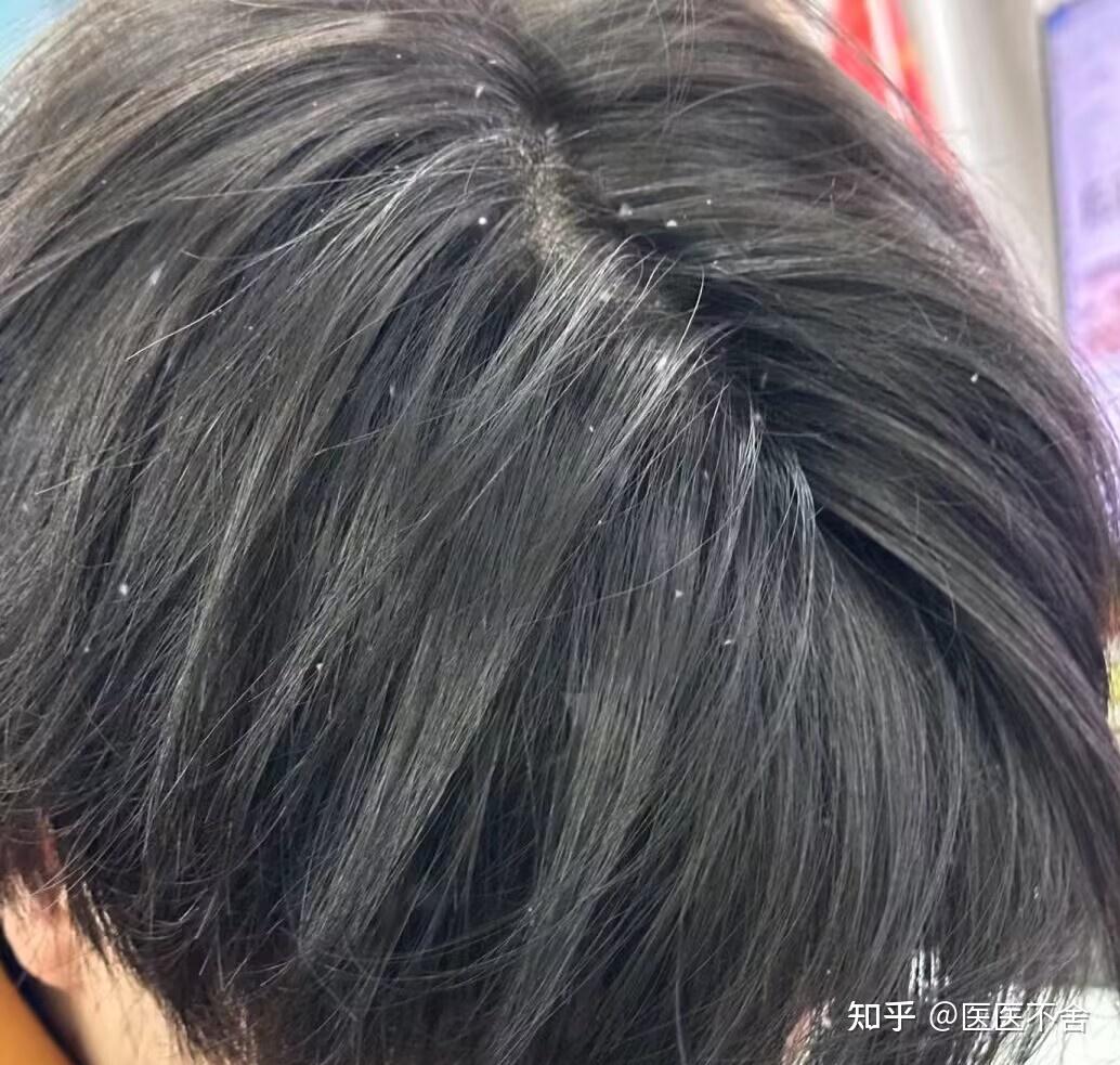 天天洗头,第二天依旧头皮屑特别多是什么原因造成的?该如何解决? - 知乎