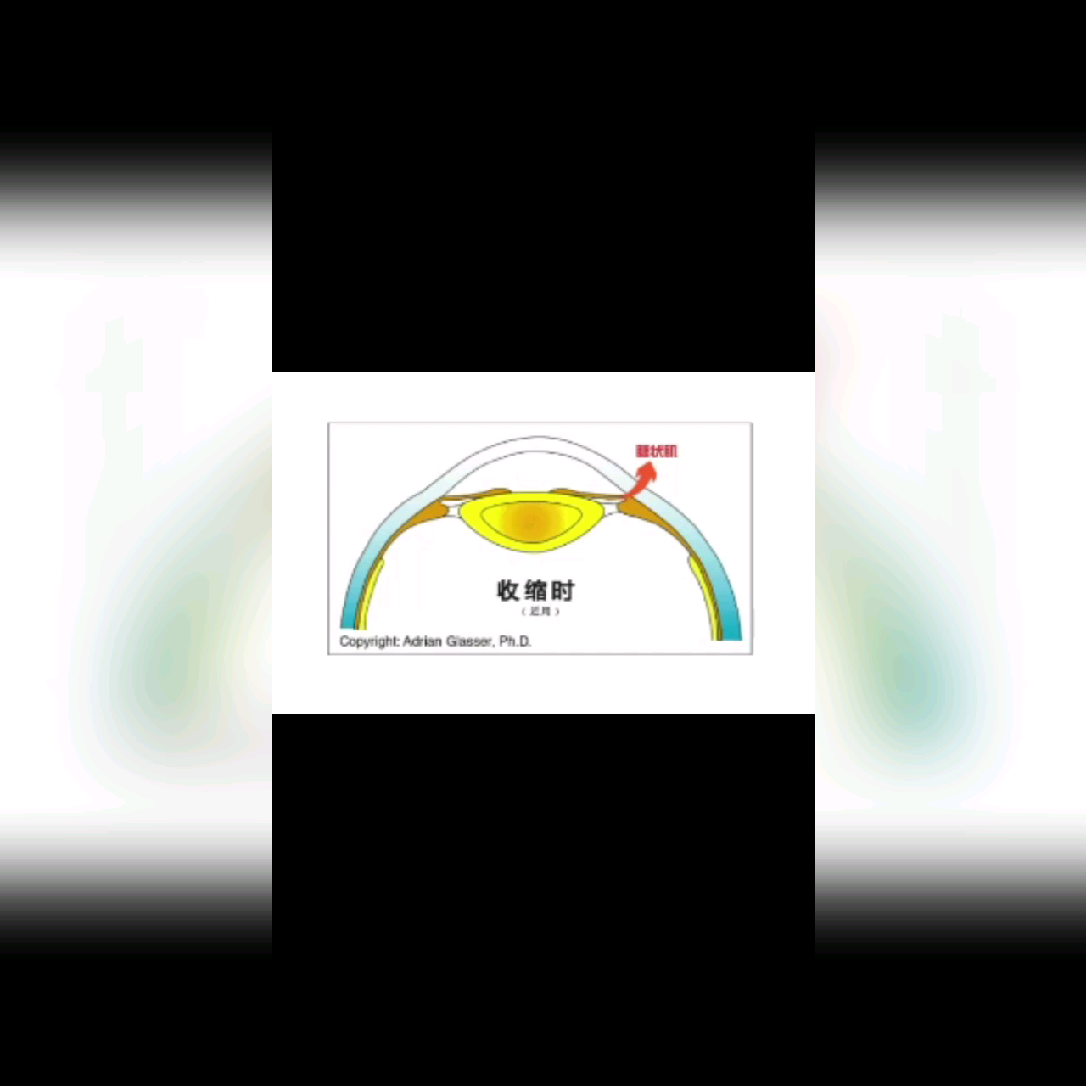 双眼视异常之调节不足 - 知乎