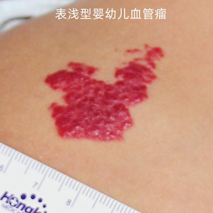 婴儿红胎记,到底应该怎么办? - 知乎