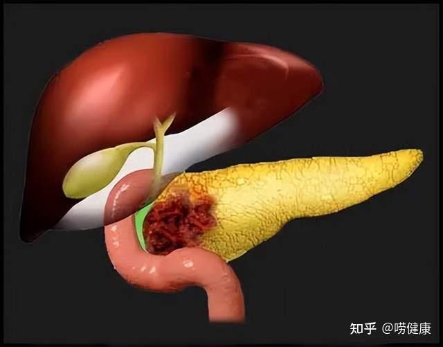 确诊胰头癌,依靠这个方法成功缩小肿瘤,实现手术切除 - 知乎