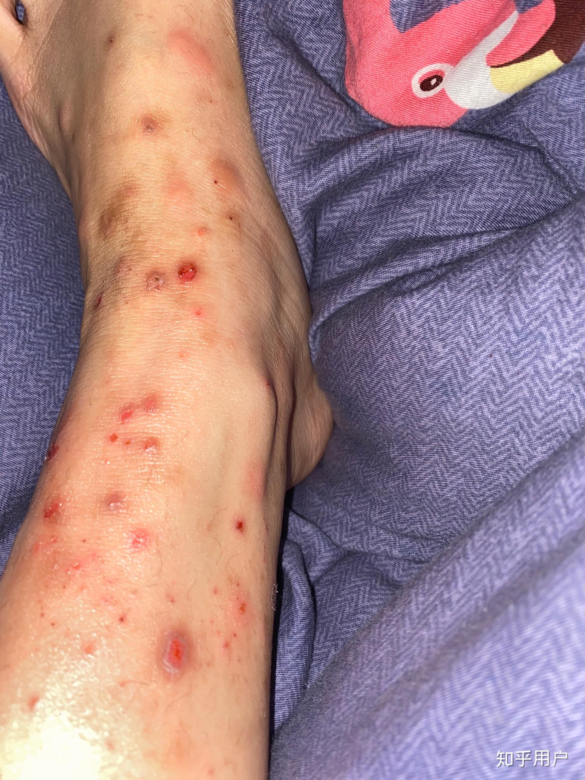 被蚊子咬了包好了结果因为痒挠破了现在化脓很厉害该怎么办呢