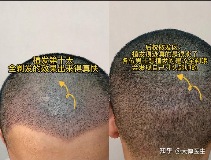 巴西植发多久能做(巴西植发多久能做头发拉直)