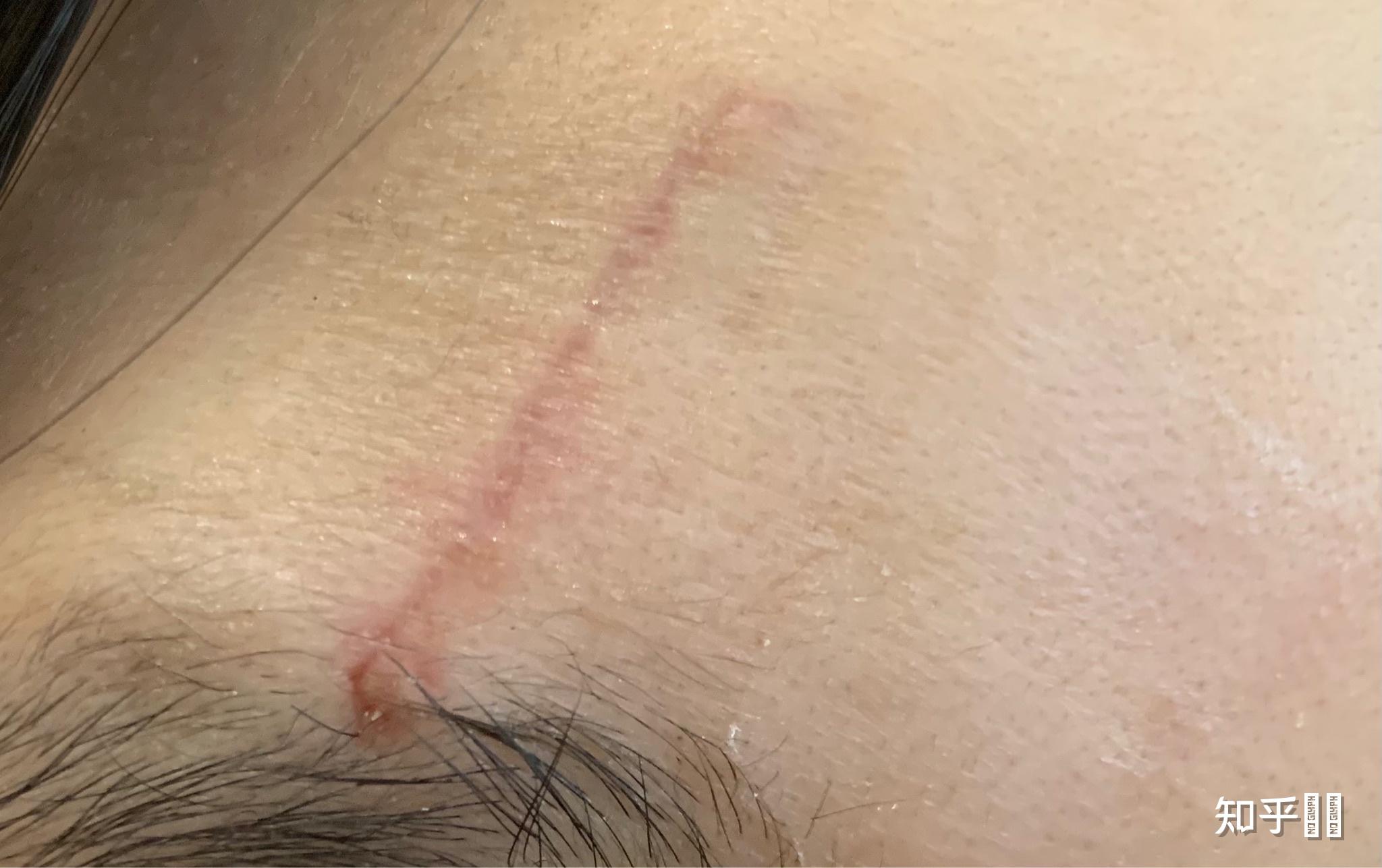 眉骨上方受伤,美容针缝合后,怎么做能减少疤痕的产生?