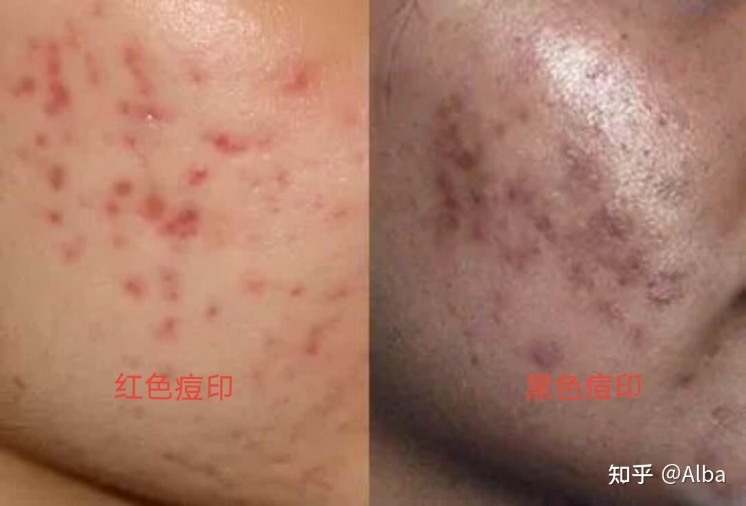 如何区分痘痘 痘印 痘坑? - 知乎
