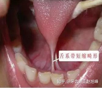 舌头下面“系带”有什么作用？ - 知乎