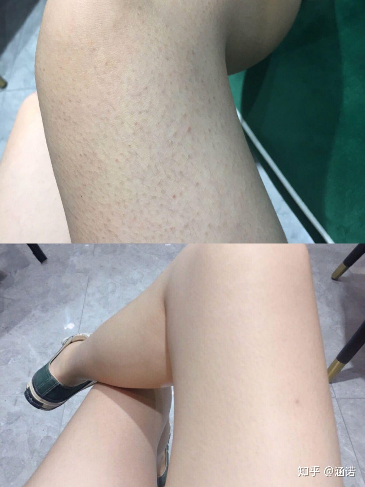 鸡皮肤容易留疤(鸡皮肤扣了之后成了疤)