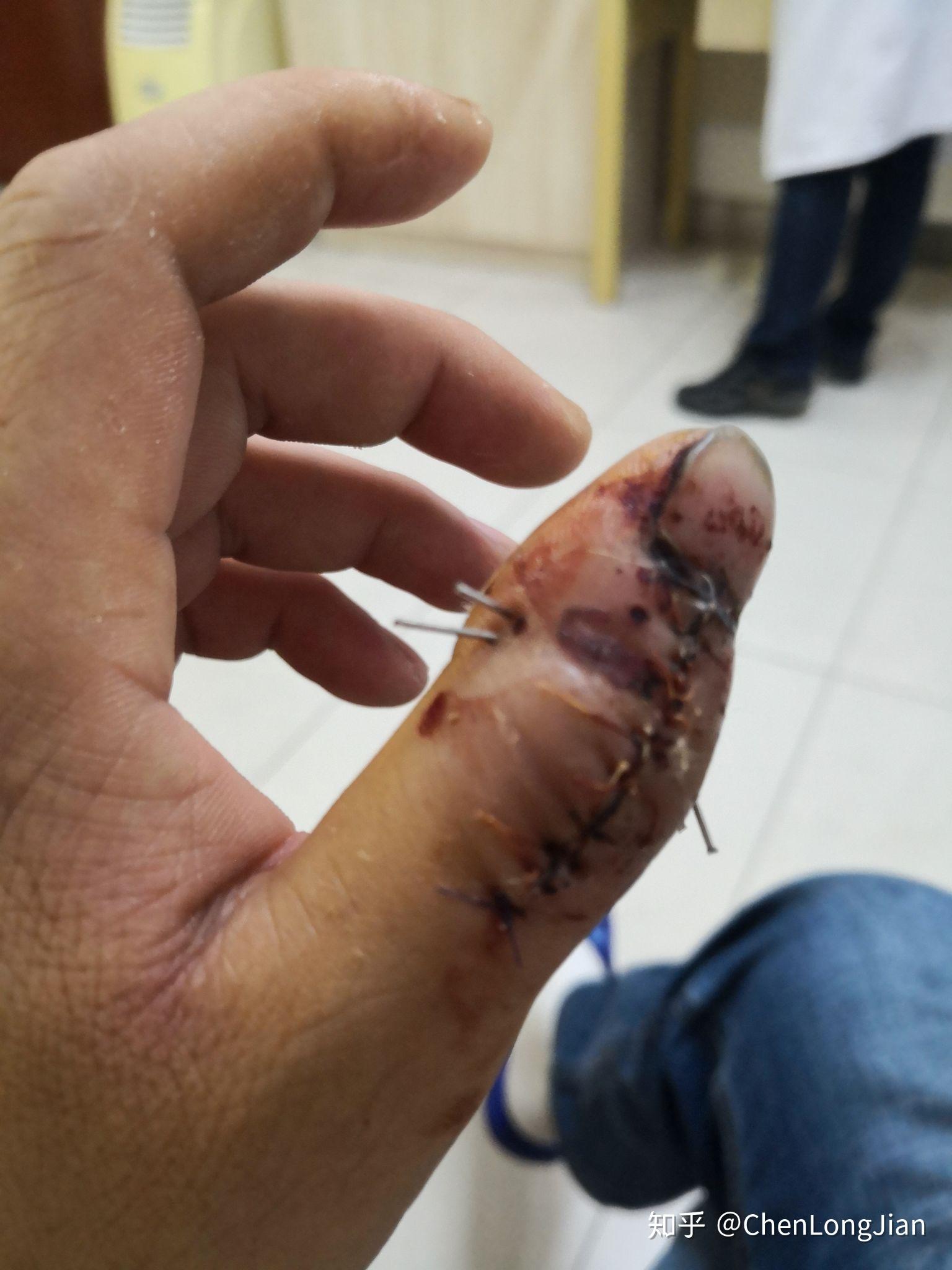 手指头骨折是种怎样的体验? - 知乎