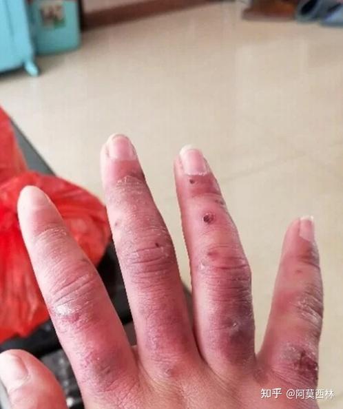 冻疮怎么治疗?治冻疮过程亲身经历!! - 知乎