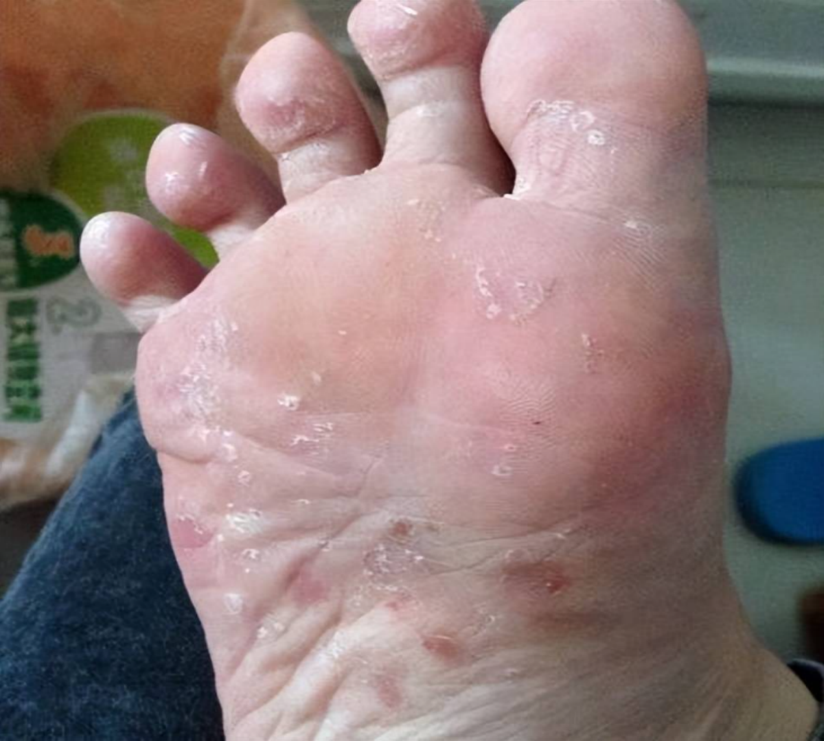 注意了脚底干痒起水泡不要抓四招就能破解困局低成本去脚气