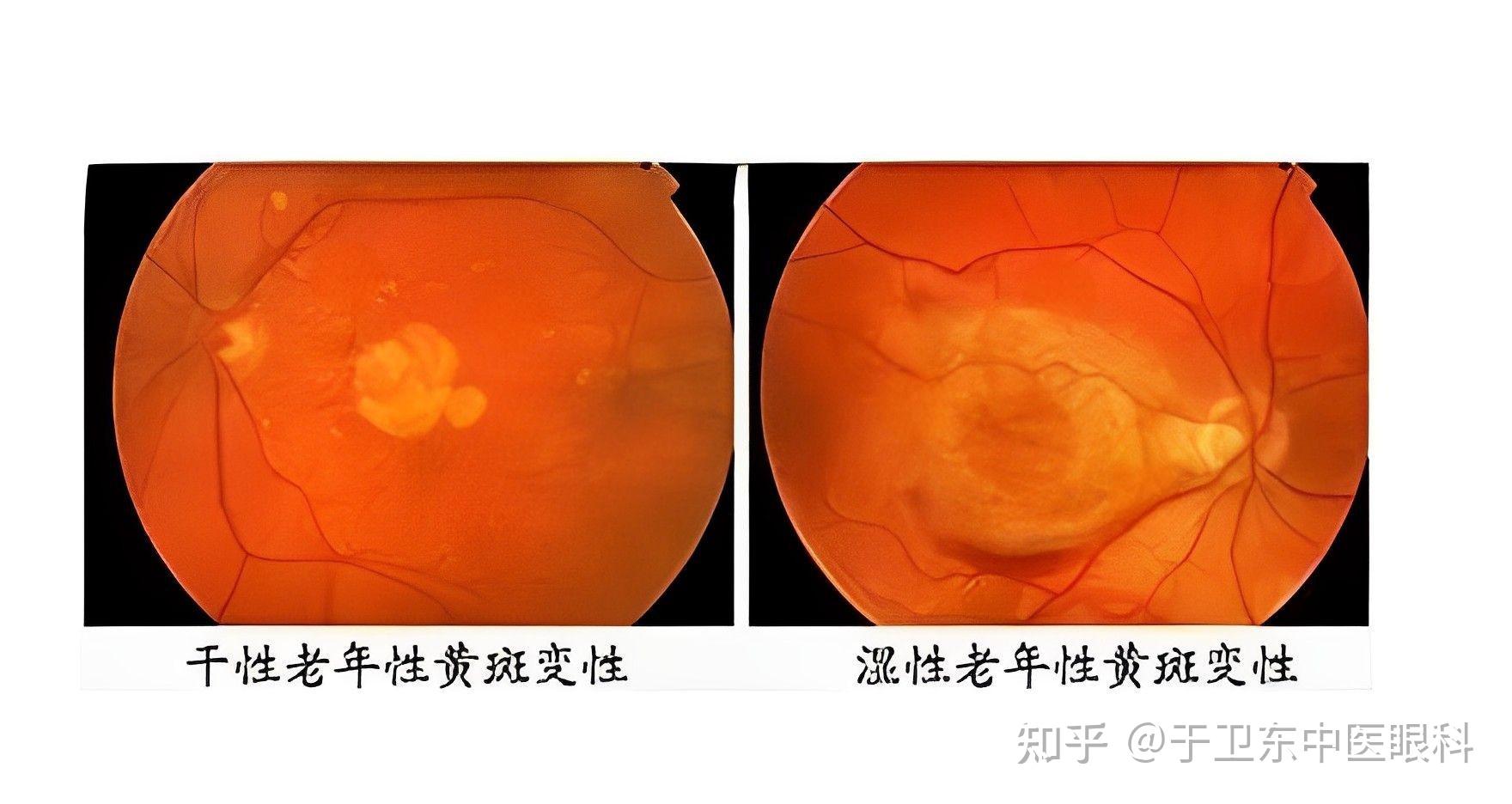 黄斑变性 这些你要早知道 - 知乎
