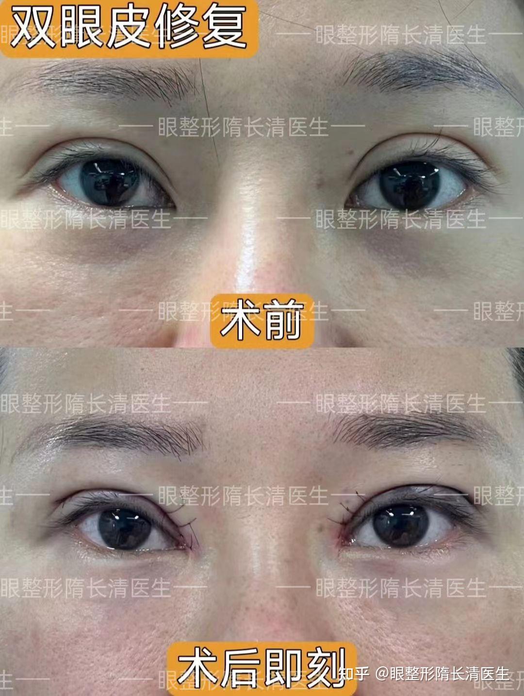 【双眼皮修复 || 术后即刻】案例分享 - 知乎