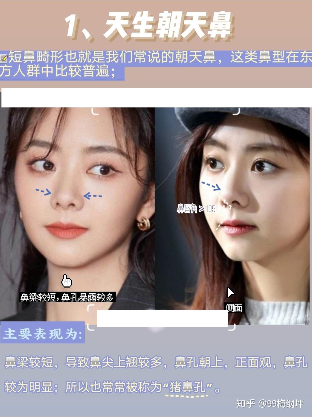 鼻孔外露怎么整形?大概需要花费多少钱呢? - 知乎
