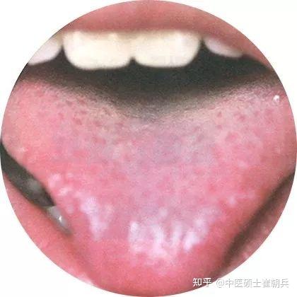 史上最全高清舌诊图谱,堪比教科书(收藏篇) - 知乎