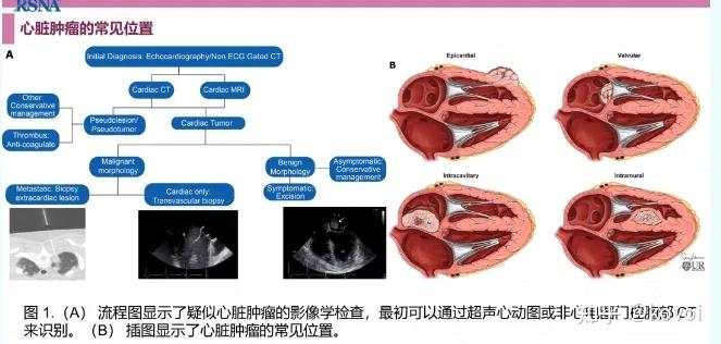 Who 中枢神经系统肿瘤的WHO分类,一起来看看! - 知乎