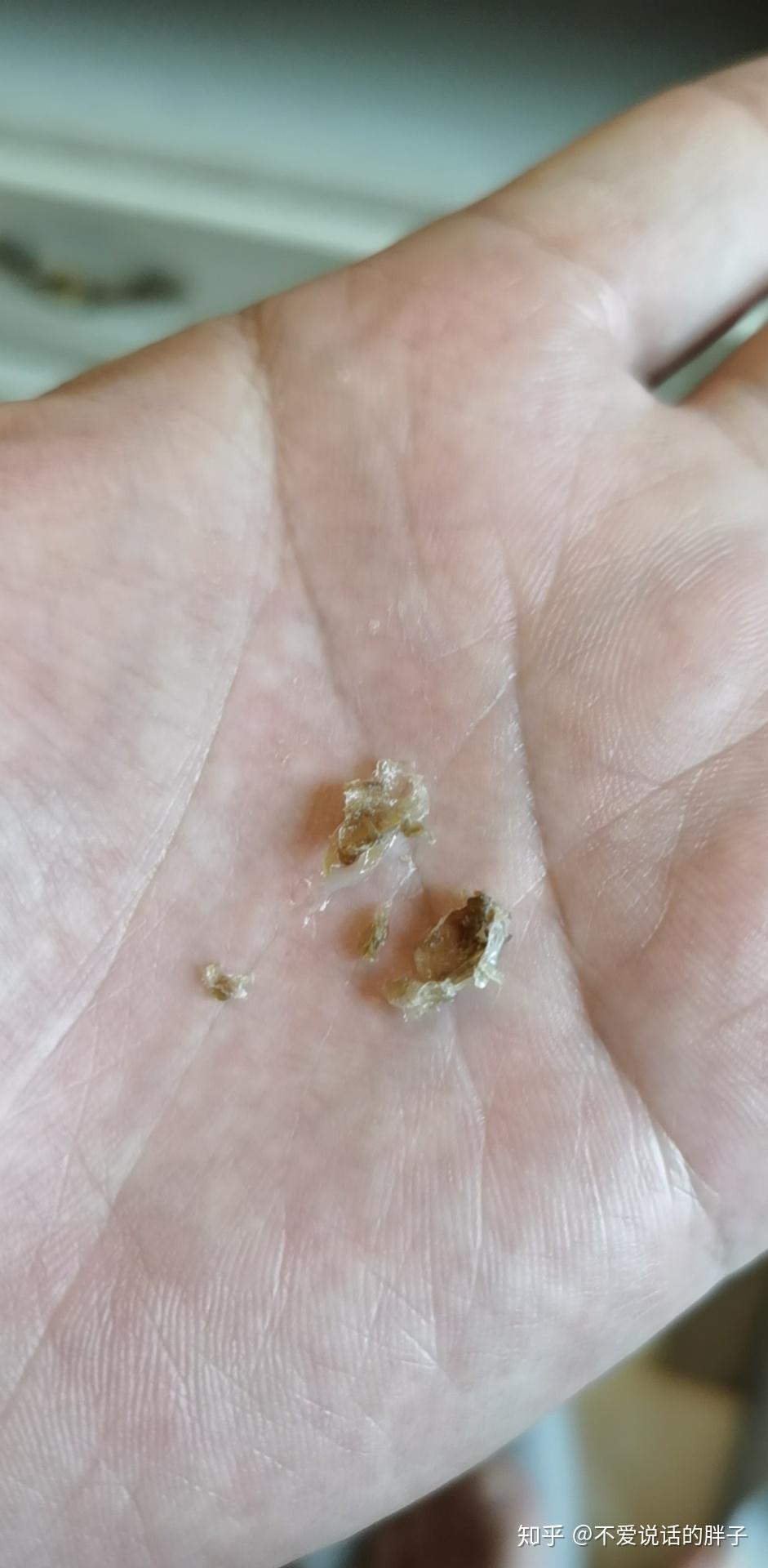 人的鼻屎能大到什么程度? - 知乎
