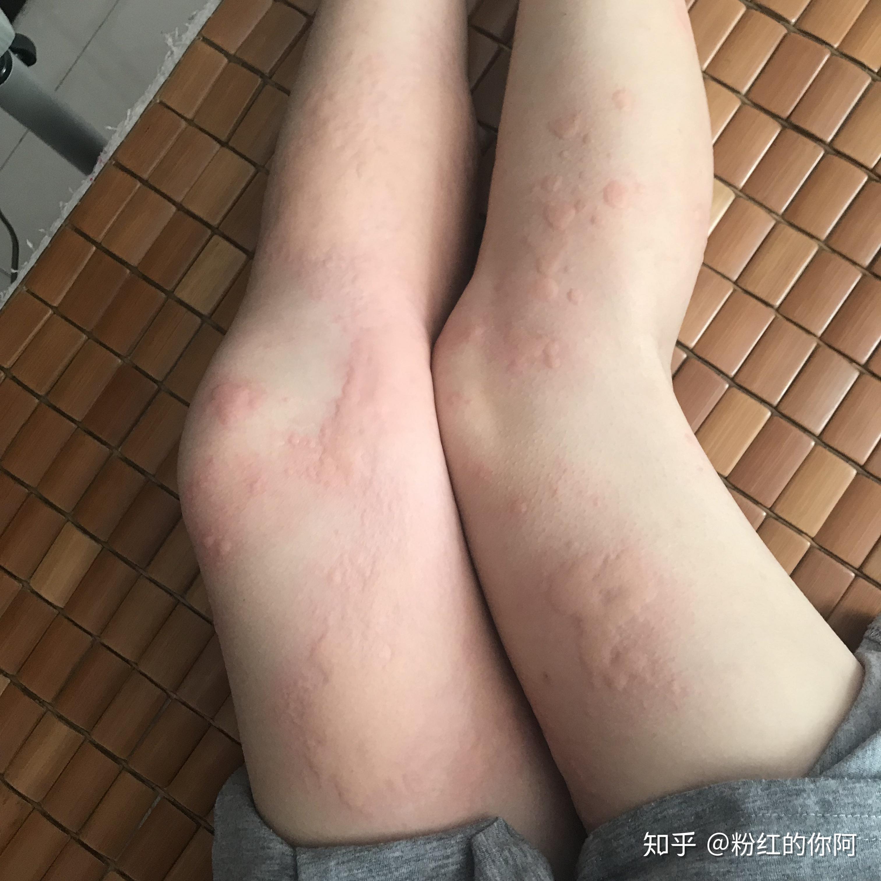 荨麻疹真的没办法根治吗