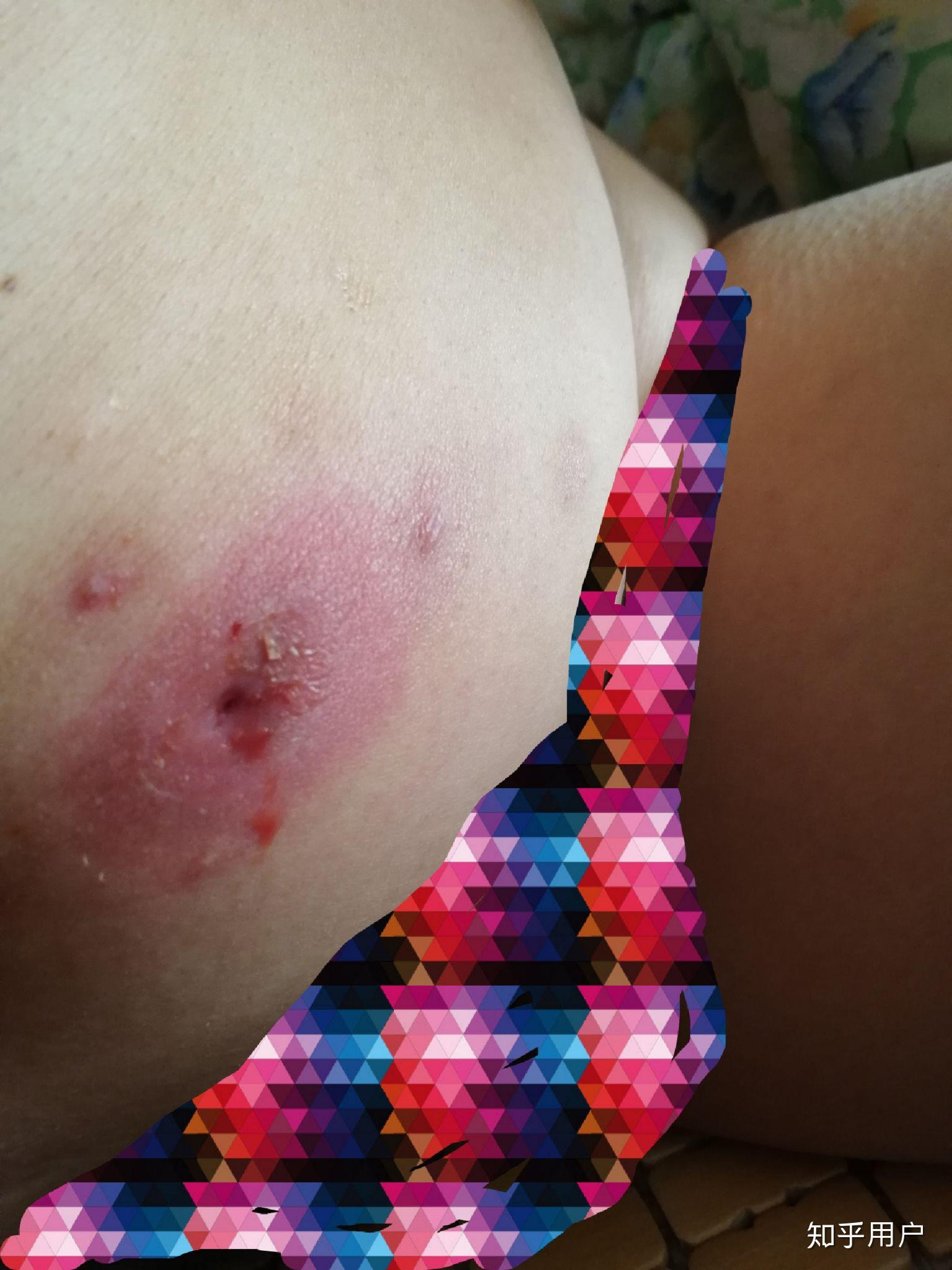 长火疖子怎么治很恐怖吗