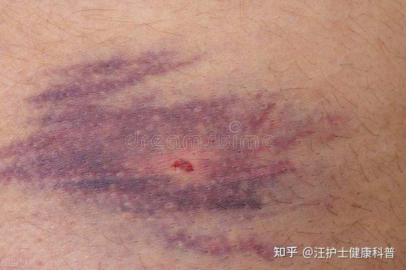 抽血后抽血处淤青得很严重? - 知乎