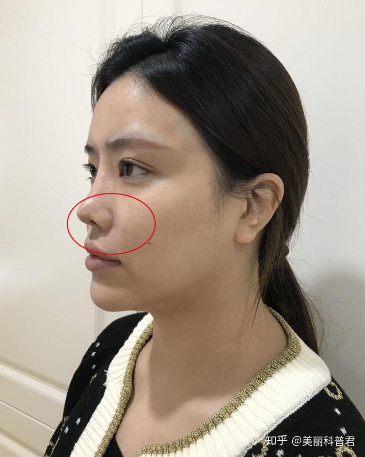 鼻基底凹陷有什么好办法
