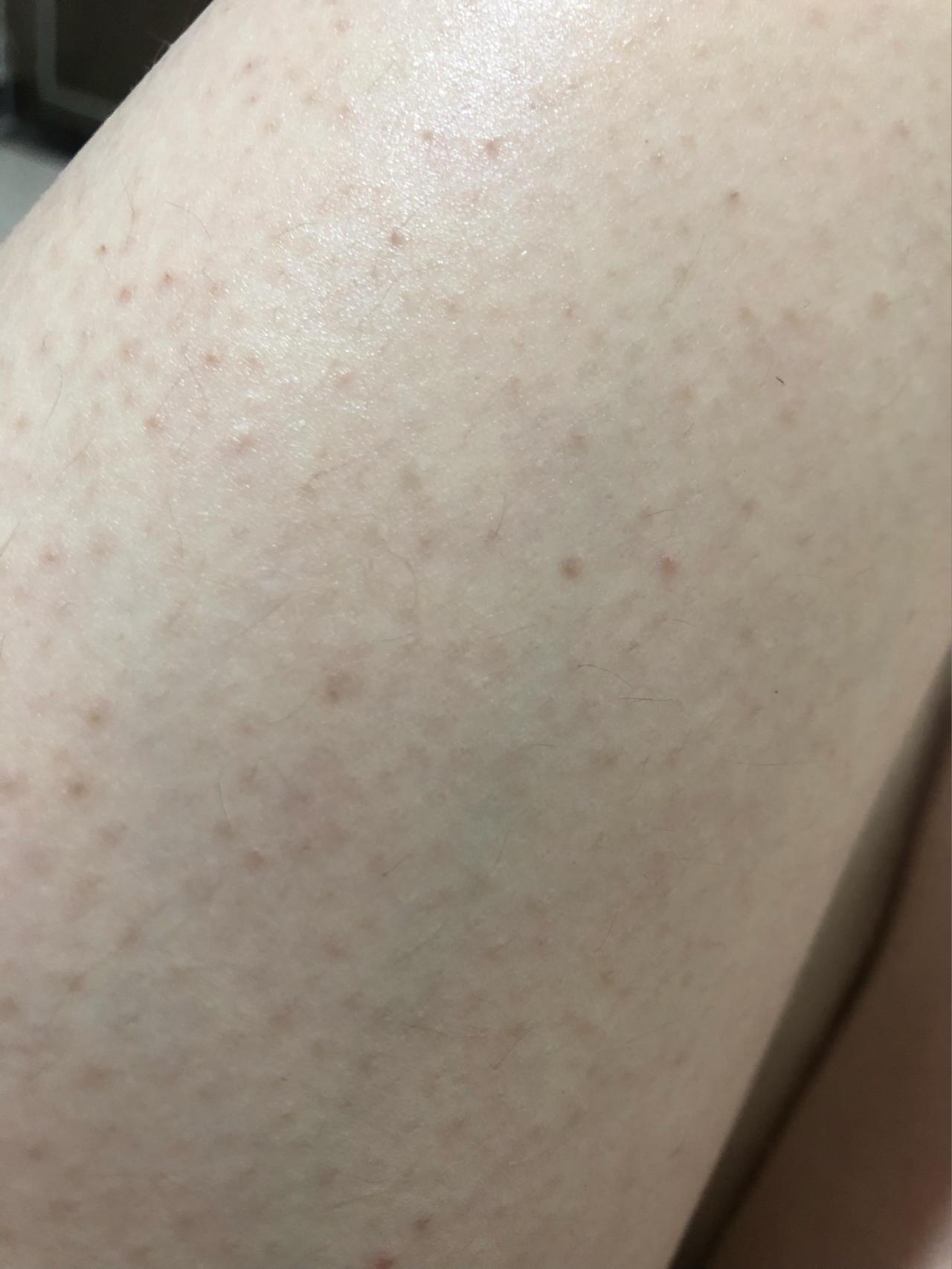 鸡皮肤留下的色素沉积(鸡皮肤留下来的黑色素沉淀)