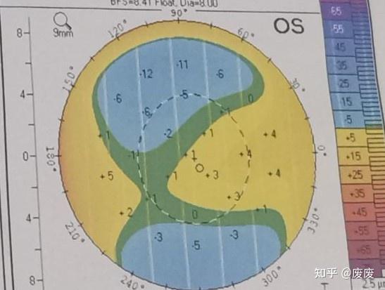 怎么看角膜地形图上的kappa角数值