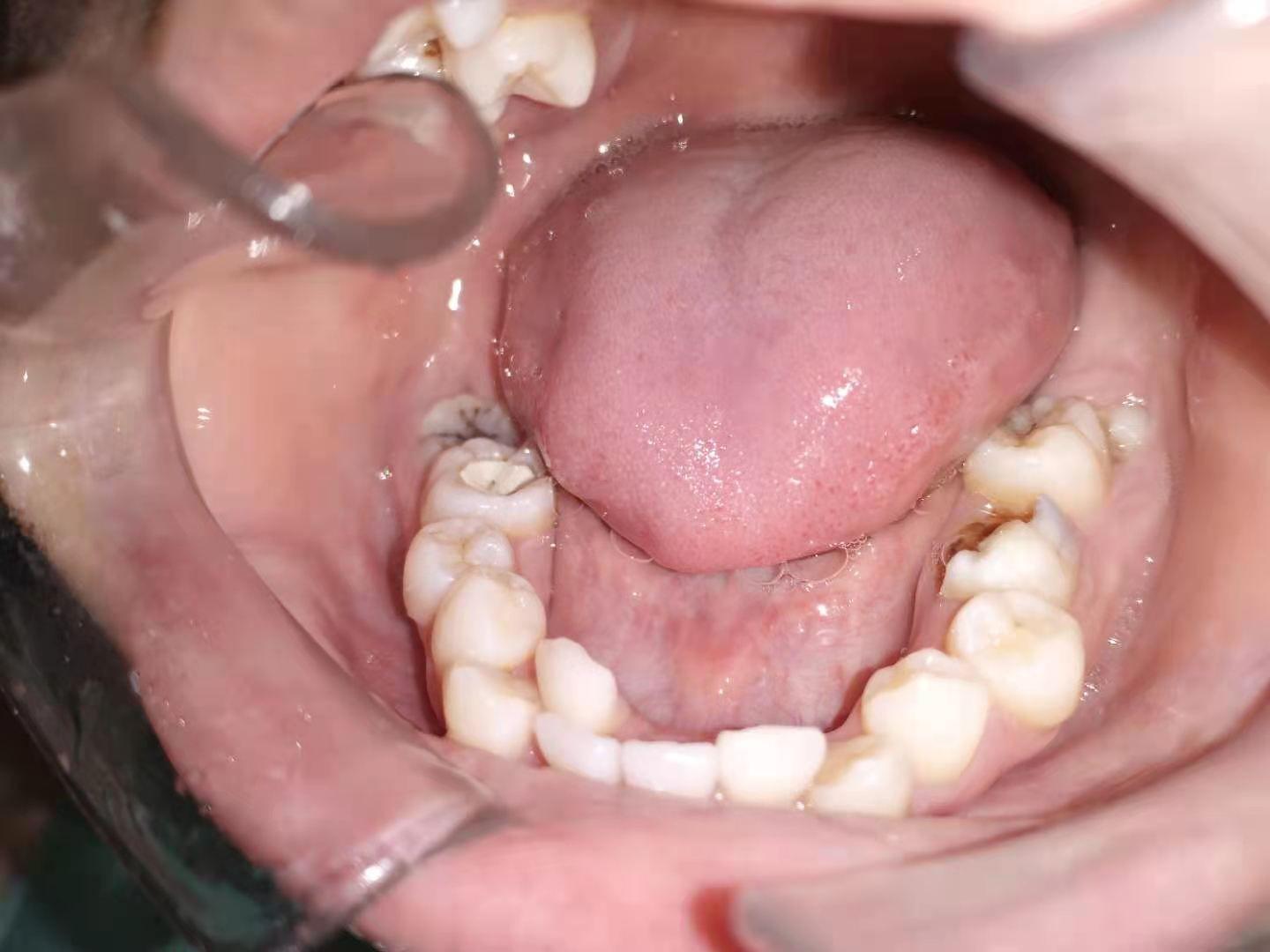 已经戴上钢牙套了还能在原来的基础上重新给大牙做根管治疗吗