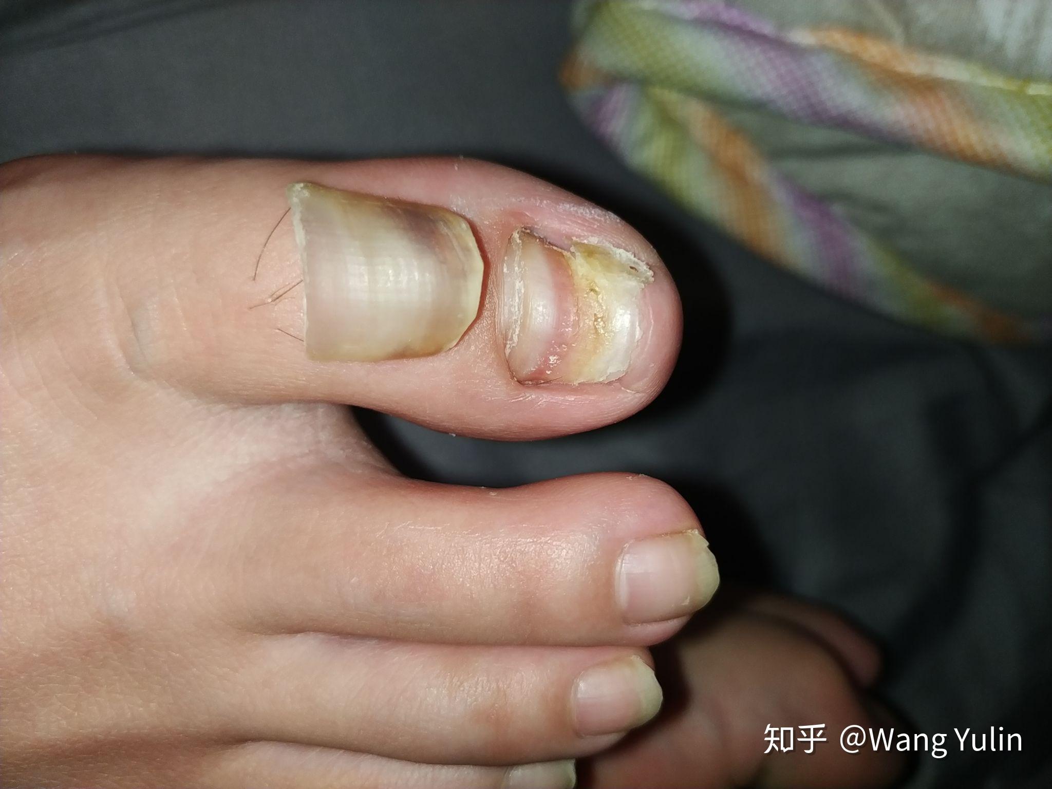 踢球脚趾甲掉了怎么办