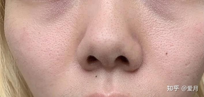 这个鼻子毛孔粗大有多严重